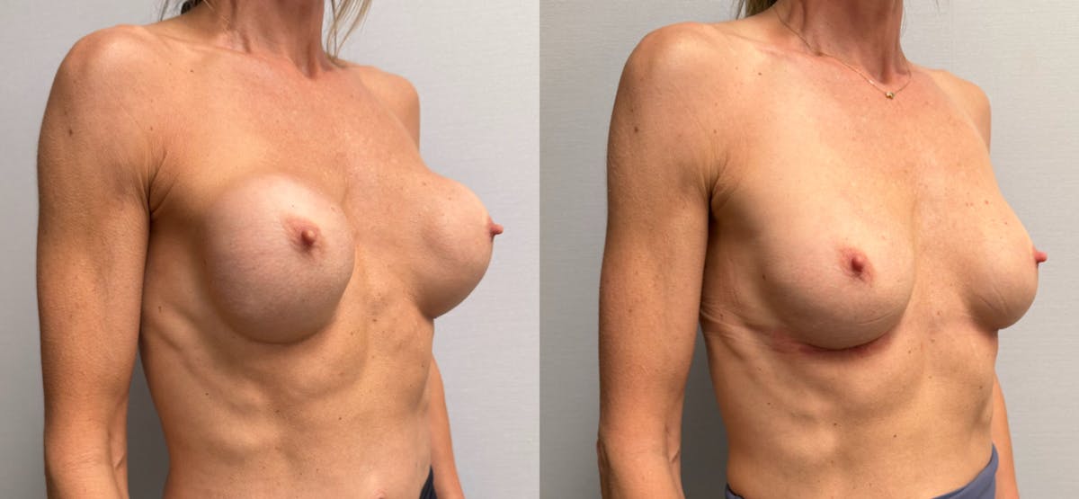 Breast Implant Exchange Before & After Gallery - Patient 229640 - Image 3