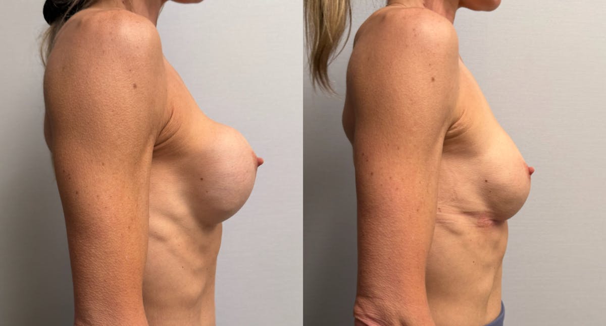 Breast Implant Exchange Before & After Gallery - Patient 229640 - Image 4