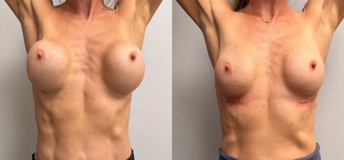 Breast Implant Exchange Before & After Gallery - Patient 229640 - Image 2