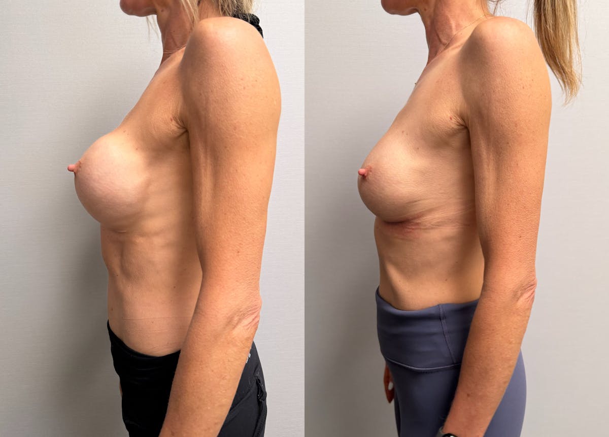 Breast Implant Exchange Before & After Gallery - Patient 229640 - Image 6