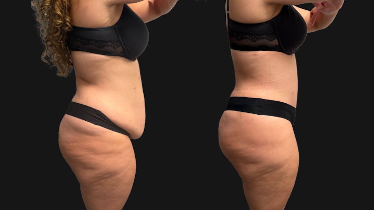 Tummy Tuck Before & After Gallery - Patient 425839 - Image 7