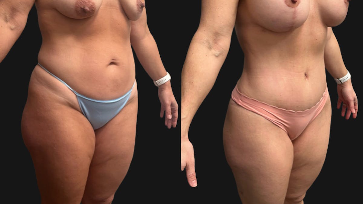 Tummy Tuck Before & After Gallery - Patient 201634 - Image 2