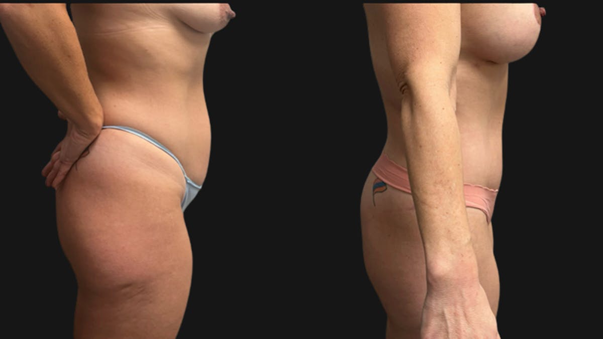 Tummy Tuck Before & After Gallery - Patient 201634 - Image 3
