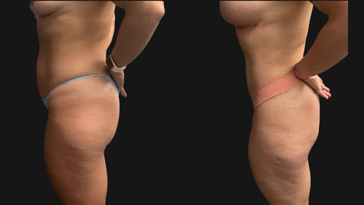 Tummy Tuck Before & After Gallery - Patient 201634 - Image 5