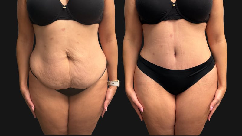 Tummy Tuck Before & After Gallery - Patient 425839 - Image 1