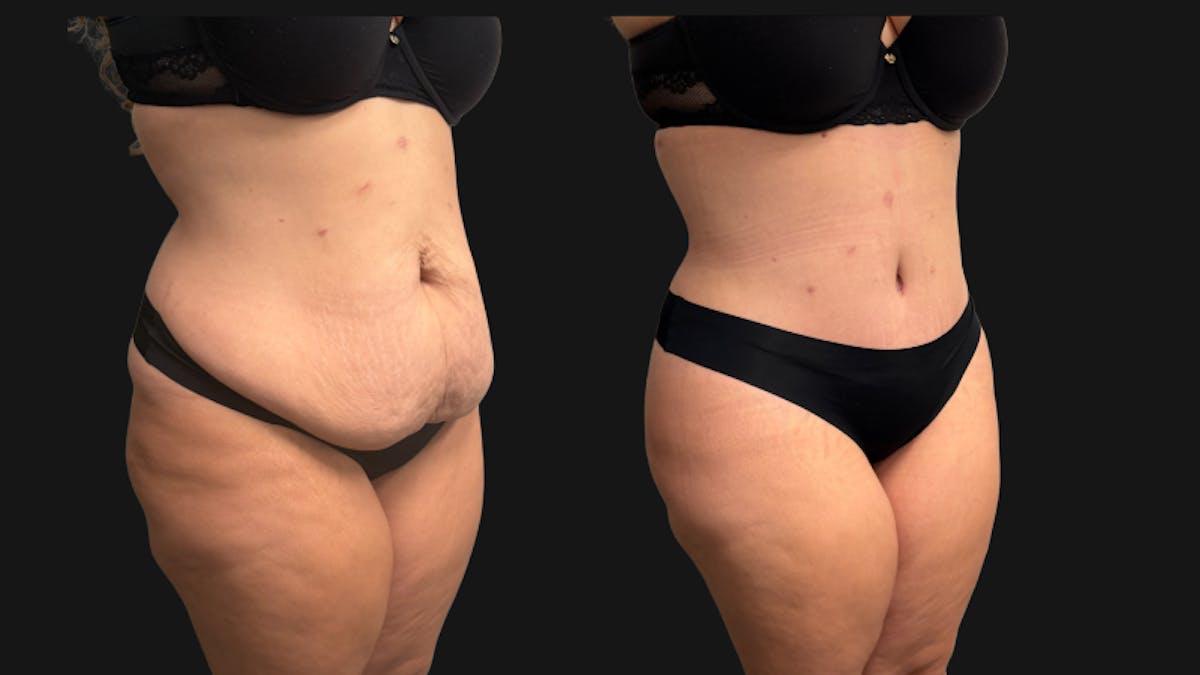 Tummy Tuck Before & After Gallery - Patient 425839 - Image 4