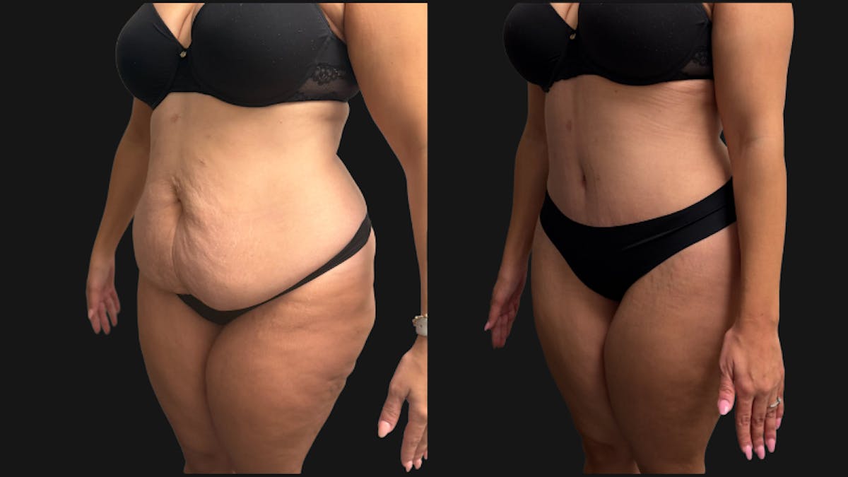 Tummy Tuck Before & After Gallery - Patient 425839 - Image 5