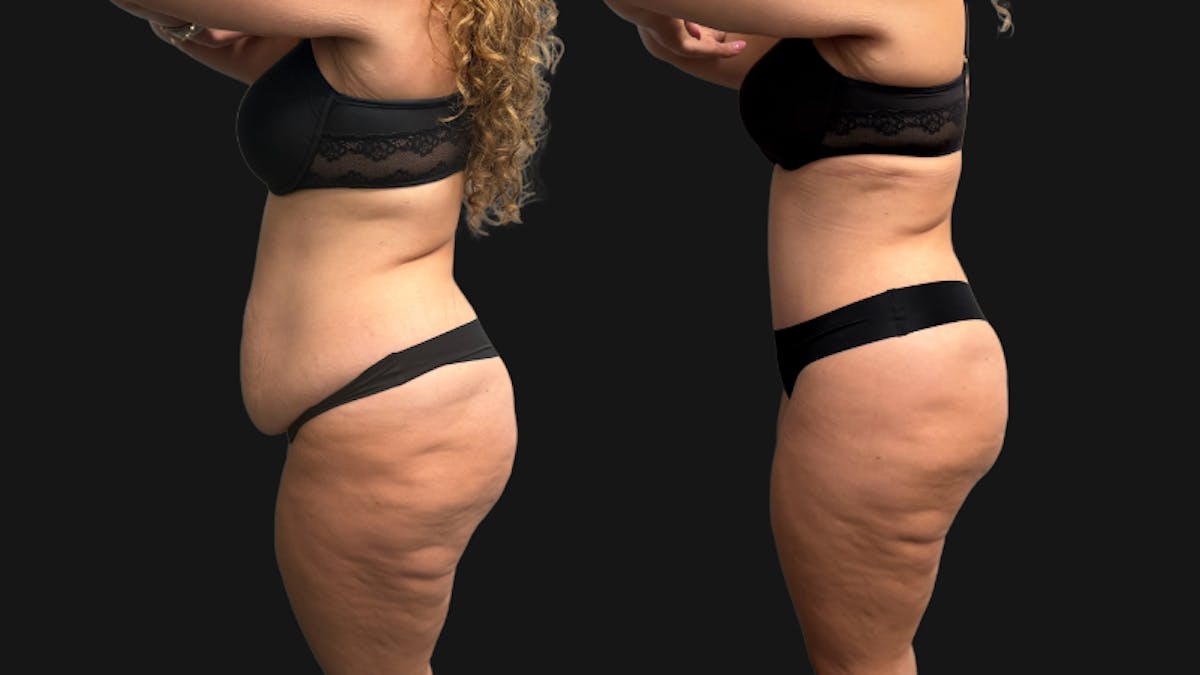 Tummy Tuck Before & After Gallery - Patient 425839 - Image 6