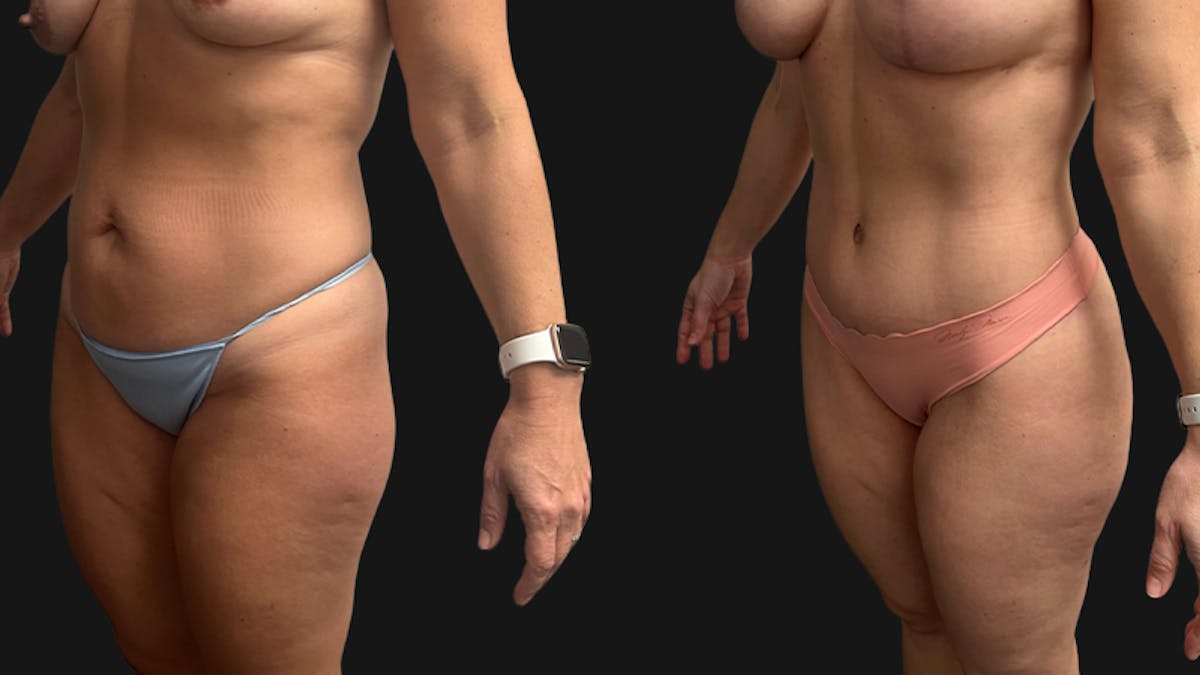 Tummy Tuck Before & After Gallery - Patient 201634 - Image 4