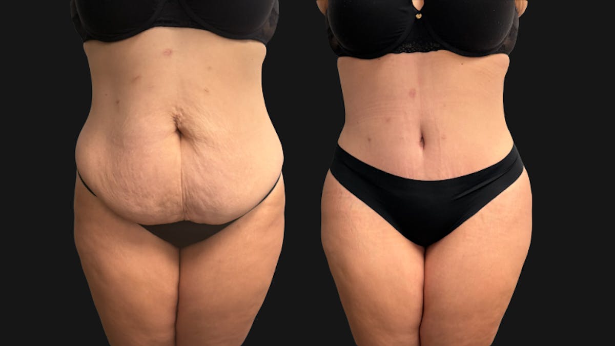 Tummy Tuck Before & After Gallery - Patient 425839 - Image 2