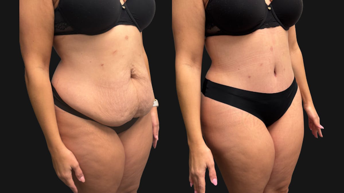 Tummy Tuck Before & After Gallery - Patient 425839 - Image 3