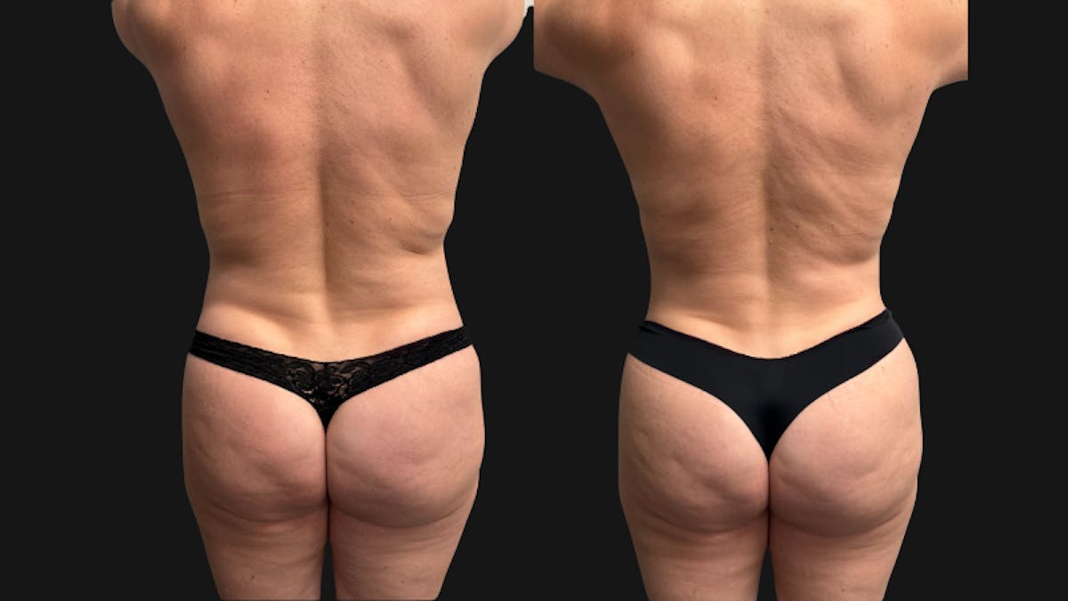 Tummy Tuck Before & After Gallery - Patient 228634 - Image 3