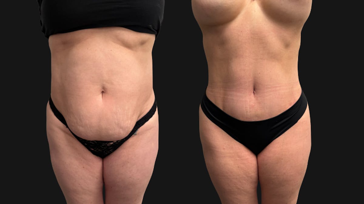 Tummy Tuck Before & After Gallery - Patient 228634 - Image 1