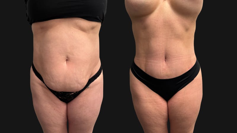 Tummy Tuck Before & After Gallery - Patient 228634 - Image 1