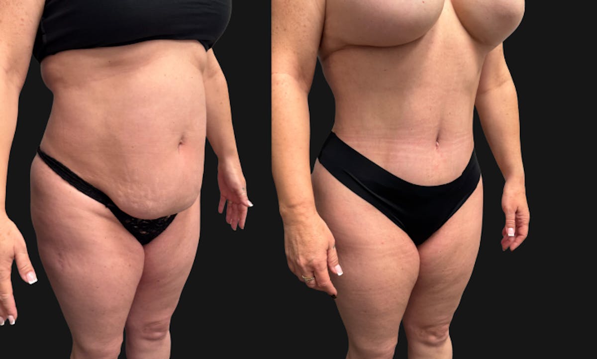 Tummy Tuck Before & After Gallery - Patient 228634 - Image 4