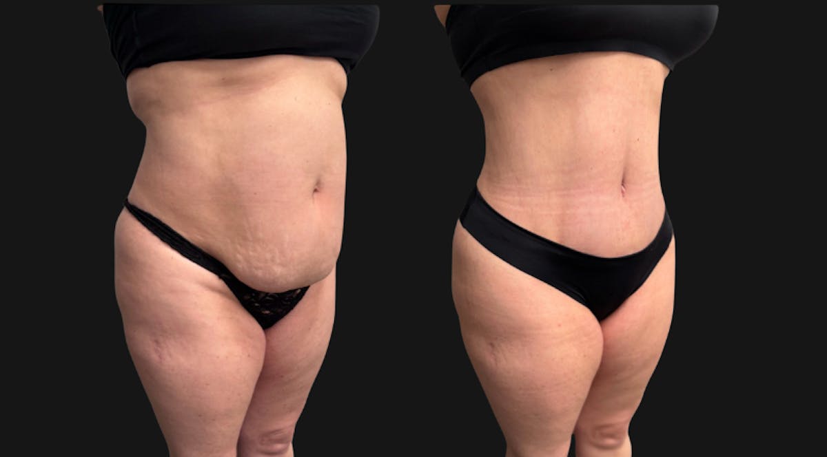 Tummy Tuck Before & After Gallery - Patient 228634 - Image 5