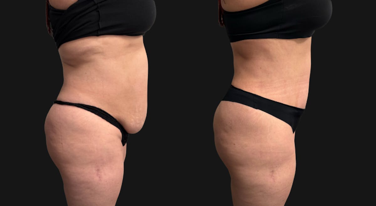 Tummy Tuck Before & After Gallery - Patient 228634 - Image 8