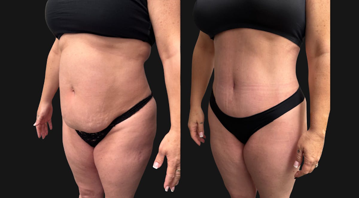 Tummy Tuck Before & After Gallery - Patient 228634 - Image 6