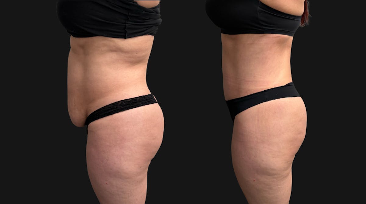 Tummy Tuck Before & After Gallery - Patient 228634 - Image 7