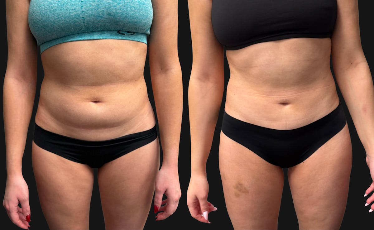 Hybrid Abdominoplasty Before & After Gallery - Patient 236572 - Image 1