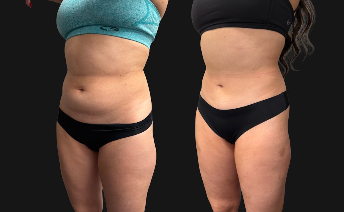 Hybrid Abdominoplasty Before & After Gallery - Patient 236572 - Image 5