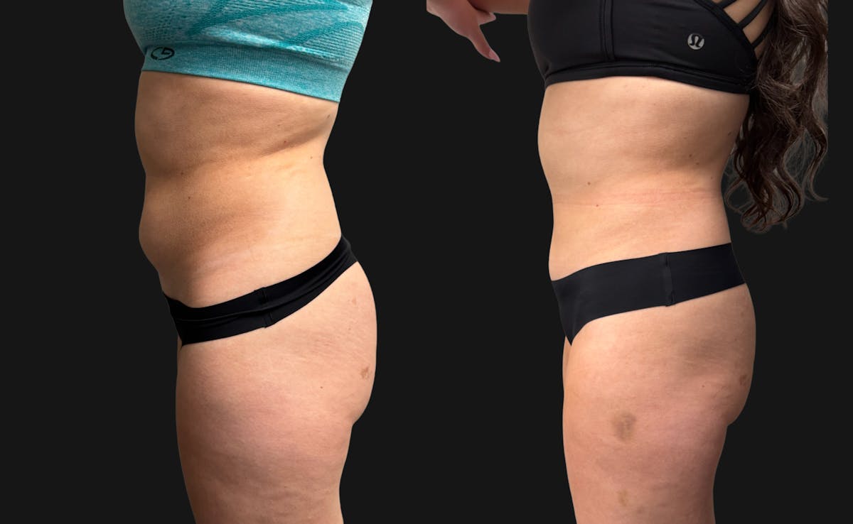 Hybrid Abdominoplasty Before & After Gallery - Patient 236572 - Image 7
