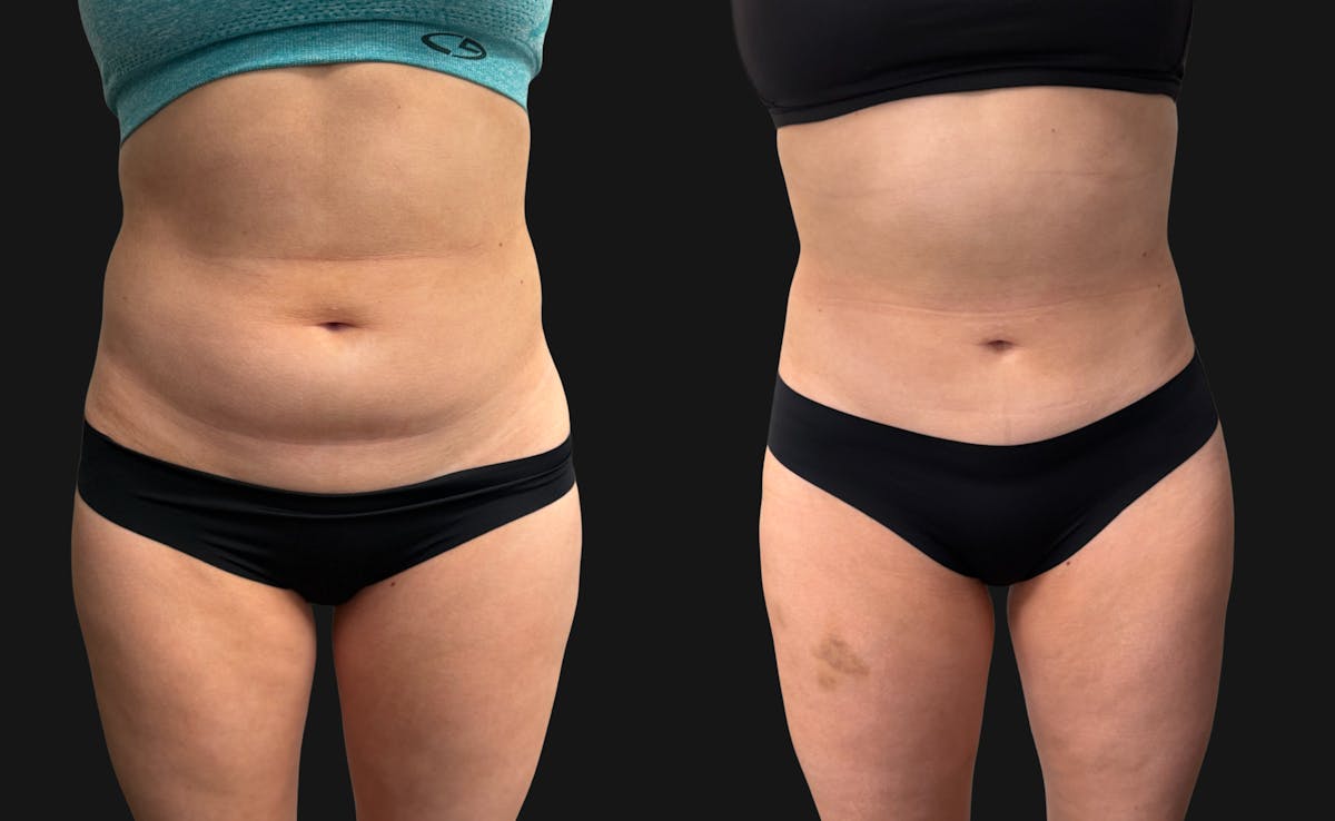 Hybrid Abdominoplasty Before & After Gallery - Patient 236572 - Image 2