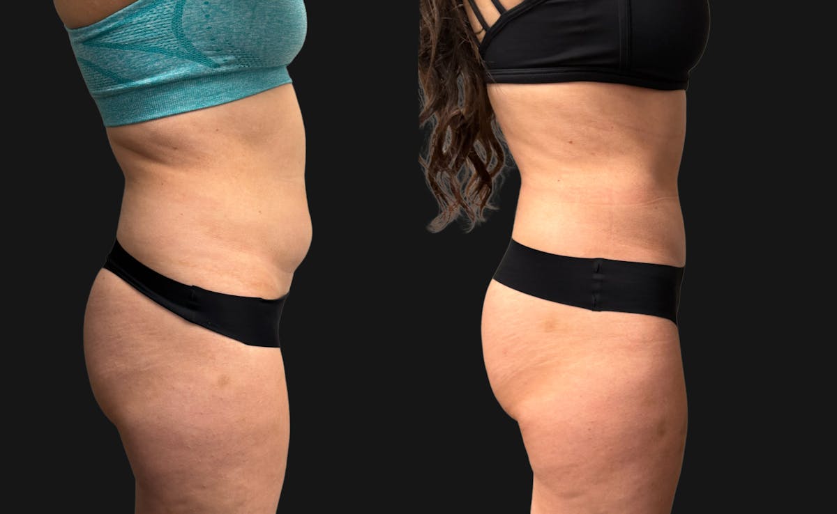 Hybrid Abdominoplasty Before & After Gallery - Patient 236572 - Image 4