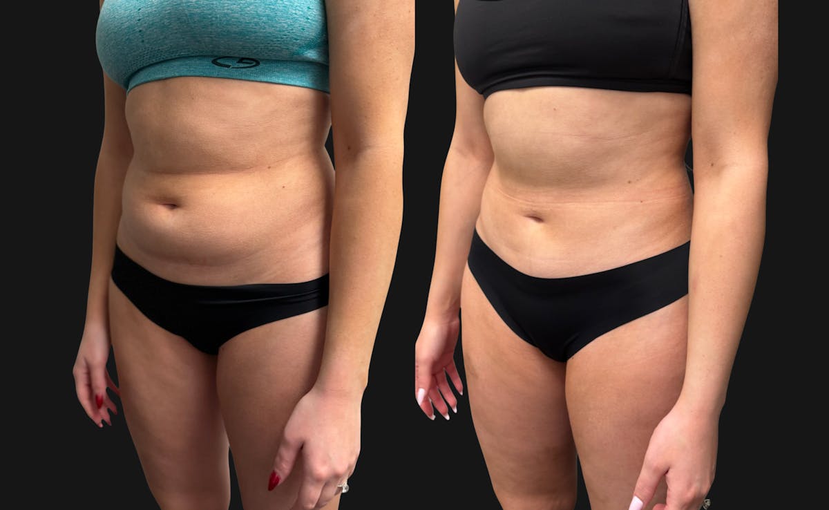 Hybrid Abdominoplasty Before & After Gallery - Patient 236572 - Image 6