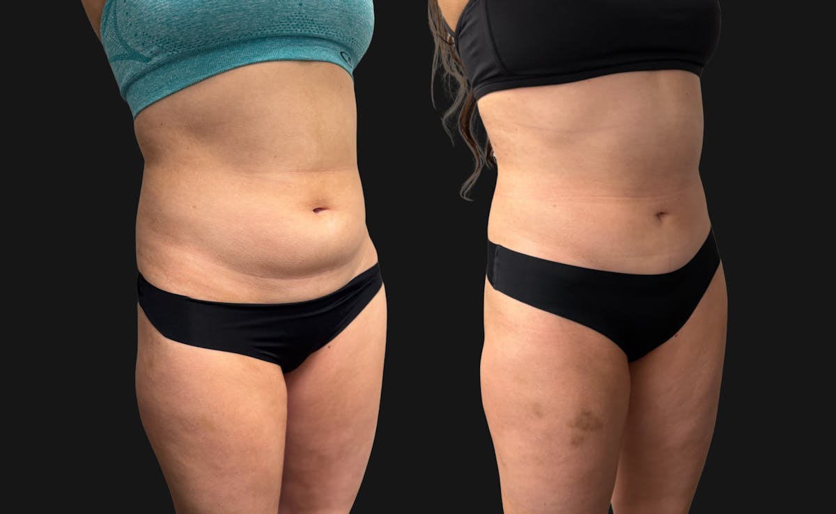 Hybrid Abdominoplasty Before & After Gallery - Patient 236572 - Image 3