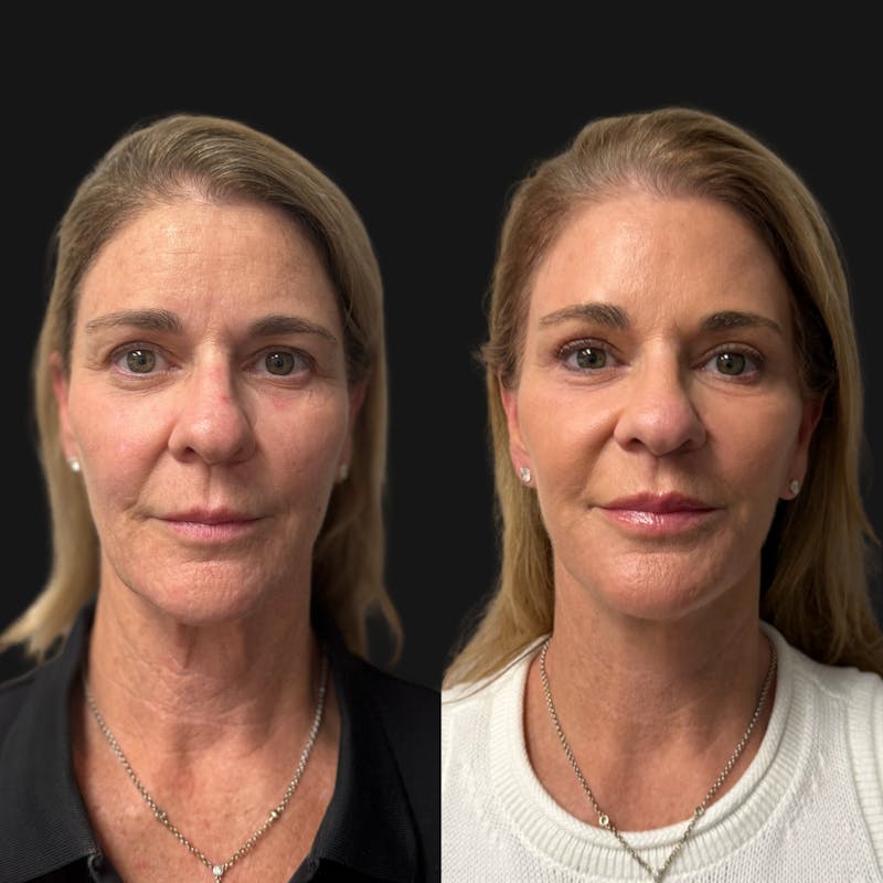 Facelift Before & After Gallery - Patient 198681 - Image 1