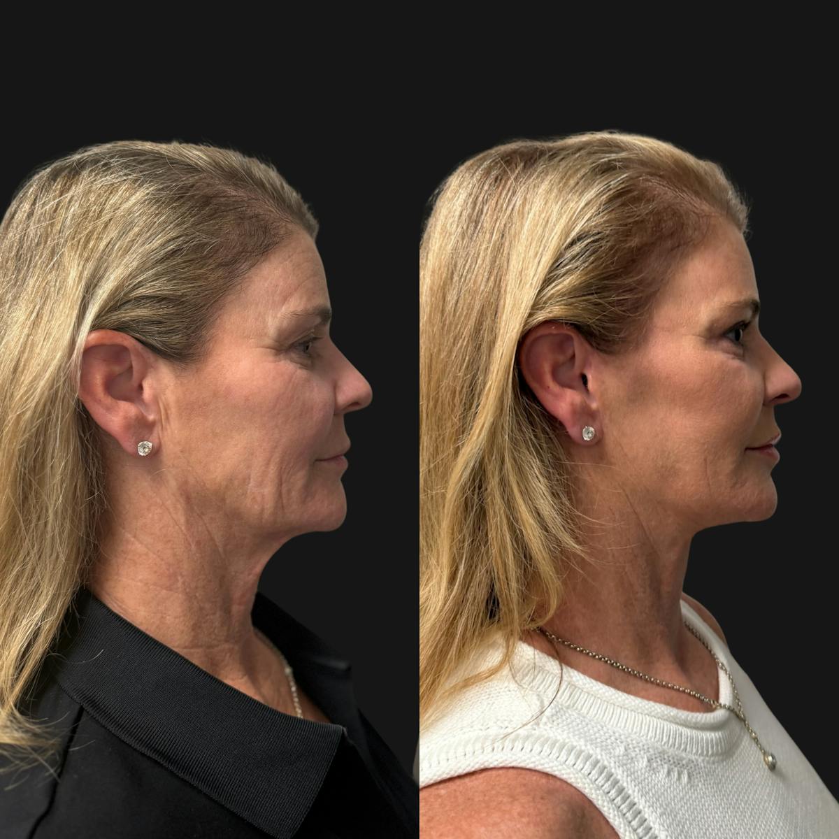 Facelift Before & After Gallery - Patient 198681 - Image 3