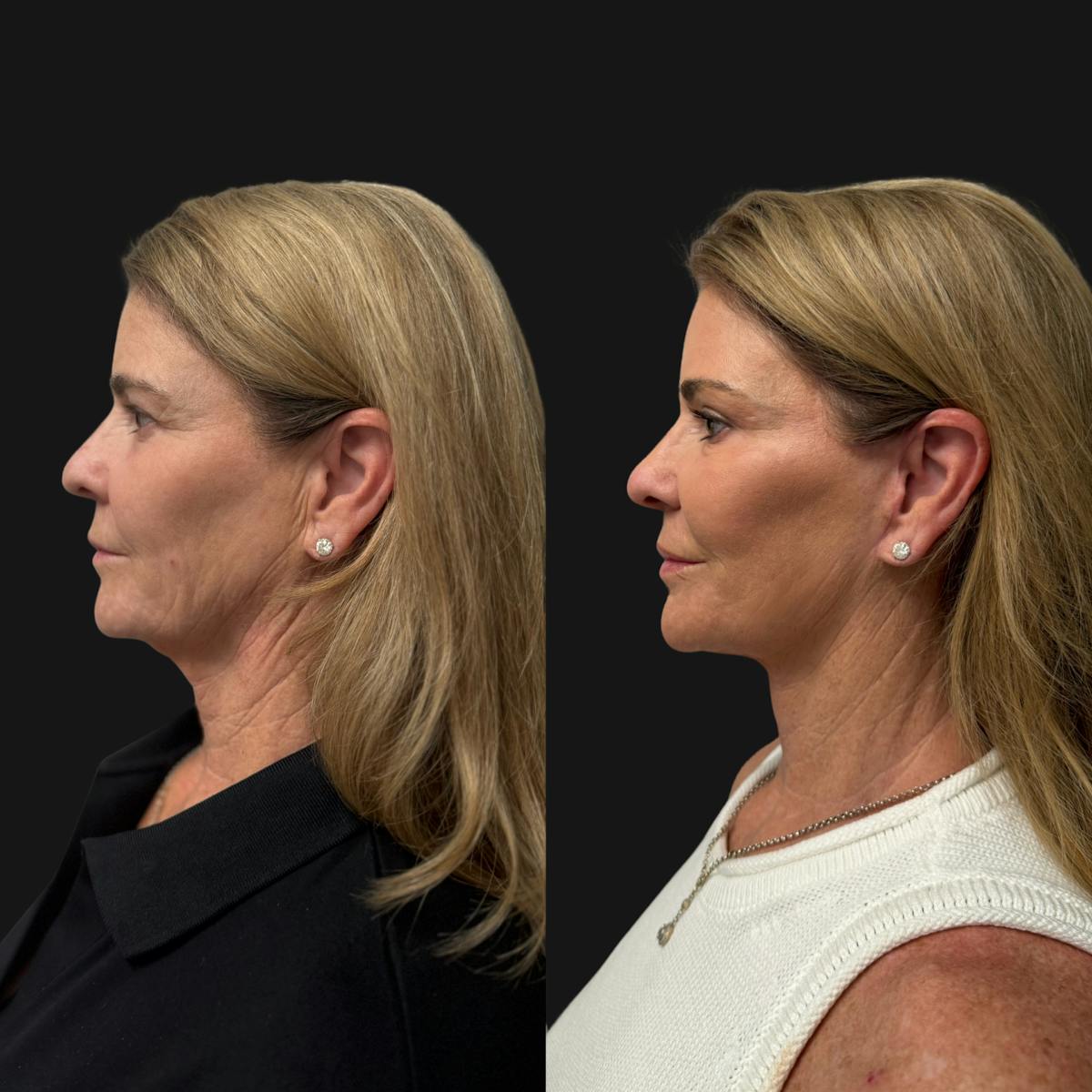 Facelift Before & After Gallery - Patient 198681 - Image 5