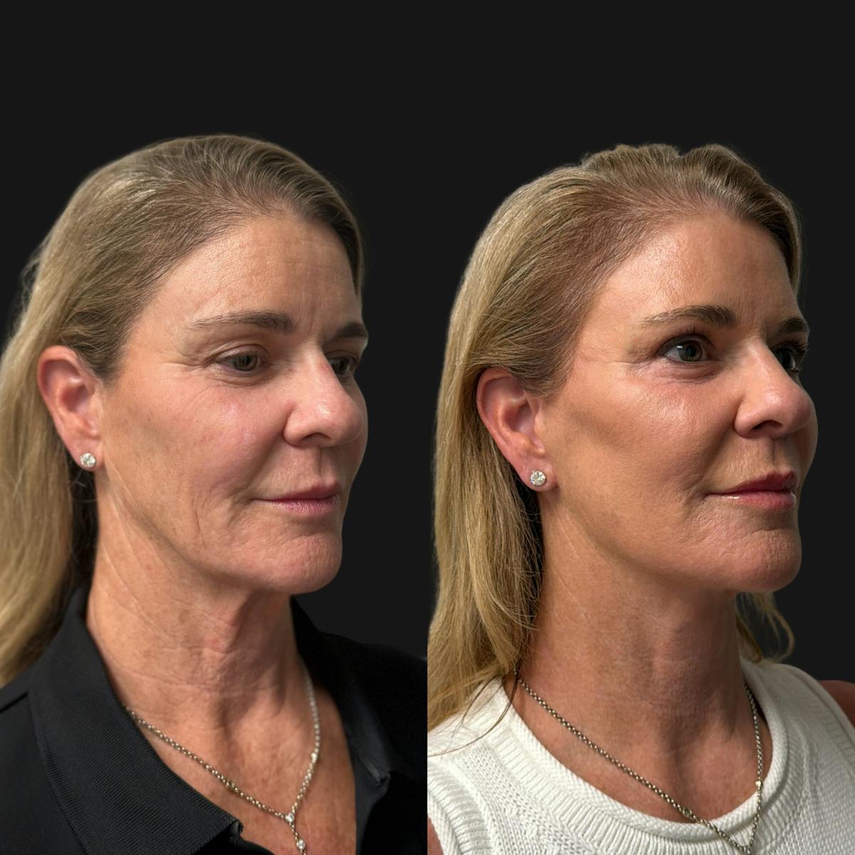 Facelift Before & After Gallery - Patient 198681 - Image 2