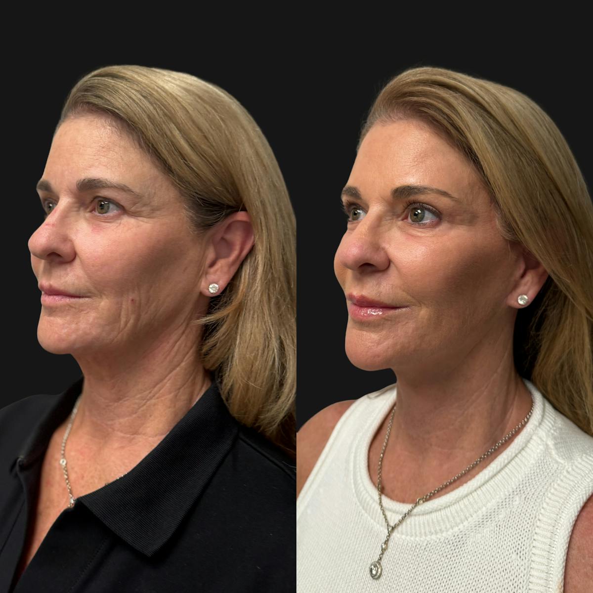 Facelift Before & After Gallery - Patient 198681 - Image 4
