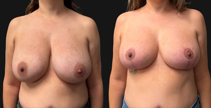 Breast Reduction Before & After Gallery - Patient 390962 - Image 1