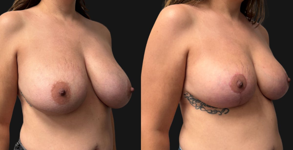 Breast Reduction Before & After Gallery - Patient 390962 - Image 2