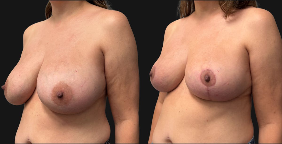 Breast Reduction Before & After Gallery - Patient 390962 - Image 4