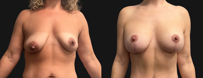 Breast Augmentation with Lift Before & After Gallery - Patient 194568 - Image 1