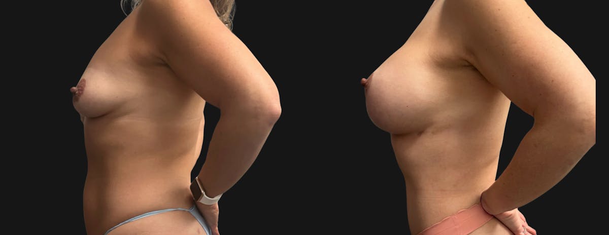 Breast Augmentation with Lift Before & After Gallery - Patient 194568 - Image 5