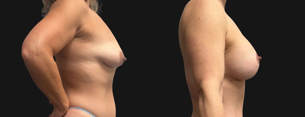 Breast Augmentation with Lift Before & After Gallery - Patient 194568 - Image 3