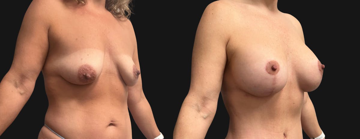 Breast Augmentation with Lift Before & After Gallery - Patient 194568 - Image 2
