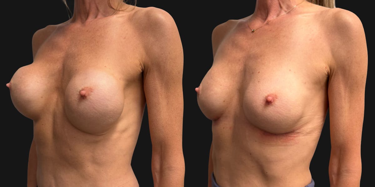 Breast Implant Exchange Before & After Gallery - Patient 229640 - Image 5