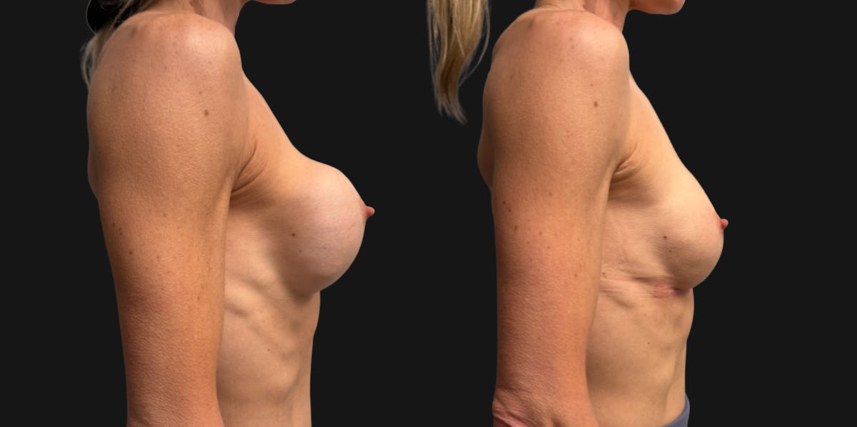 Breast Implant Exchange Before & After Gallery - Patient 229640 - Image 4