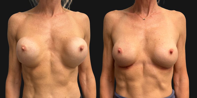 Breast Implant Exchange Before & After Gallery - Patient 229640 - Image 1