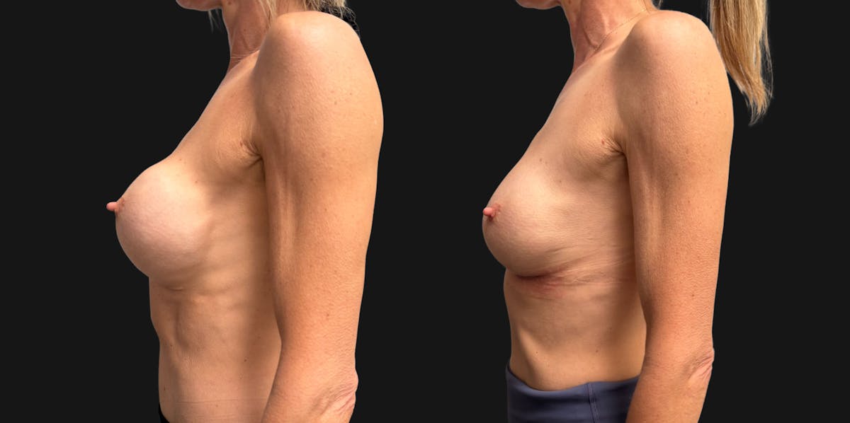 Breast Implant Exchange Before & After Gallery - Patient 229640 - Image 6
