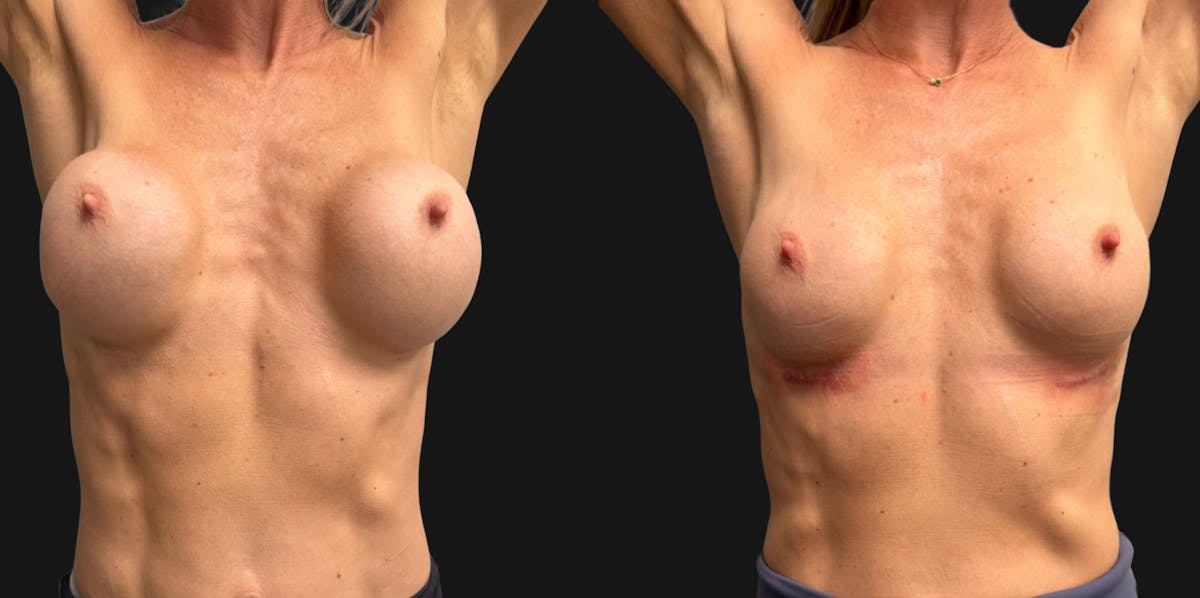 Breast Implant Exchange Before & After Gallery - Patient 229640 - Image 2