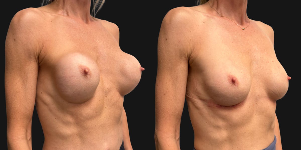 Breast Implant Exchange Before & After Gallery - Patient 229640 - Image 3