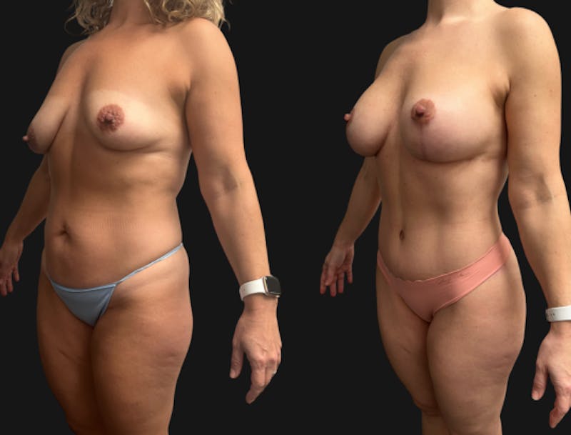 Mommy Makeover Before & After Gallery - Patient 224557 - Image 1