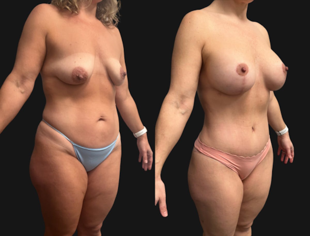 Mommy Makeover Before & After Gallery - Patient 224557 - Image 2